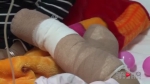 插线板起火引发火灾 十月大女婴严重烧伤双足截肢 - 重庆晨网