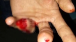 阿拉斯加犬蛰伏楼道内 一市民手指被咬断 - 重庆晨网