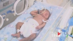 奇迹！6个月超早产女婴活下来了 出生时仅585克 - 重庆晨网