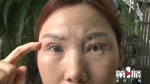 两次手术后，双眼皮还是看起怪怪的…… - 重庆晨网