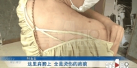 女子美容院“排毒”被烫伤 医生：瘢痕修复需一到两年 - 重庆晨网