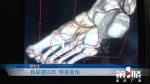 男子手术后伤口疼痛一个月 检查发现脚掌里还有一块玻璃碎片 - 重庆晨网