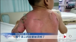 3岁男童掉进热水烫伤严重，尚未脱离危险 - 重庆晨网