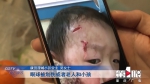 小区出入口设“铁丝网” 2岁男童闯入脸被划伤缝8针 - 重庆晨网